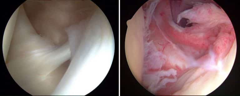 Imagen comparativa de un hombro con Capsulitis adhesiva y uno sano Imagen comparativa de un hombro con Capsulitis adhesiva y uno sano