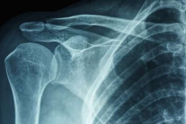 Diagnostico de la Capsulitis Adhesiva Diagnostico de la Capsulitis Adhesiva