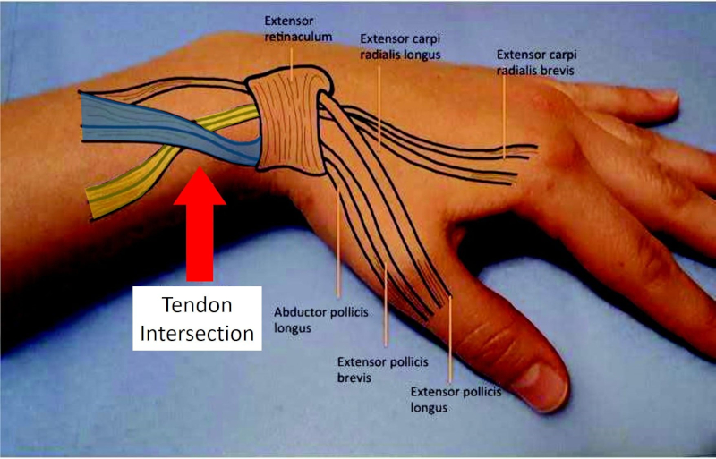 Diagrama del sindrome e intersección de tendones