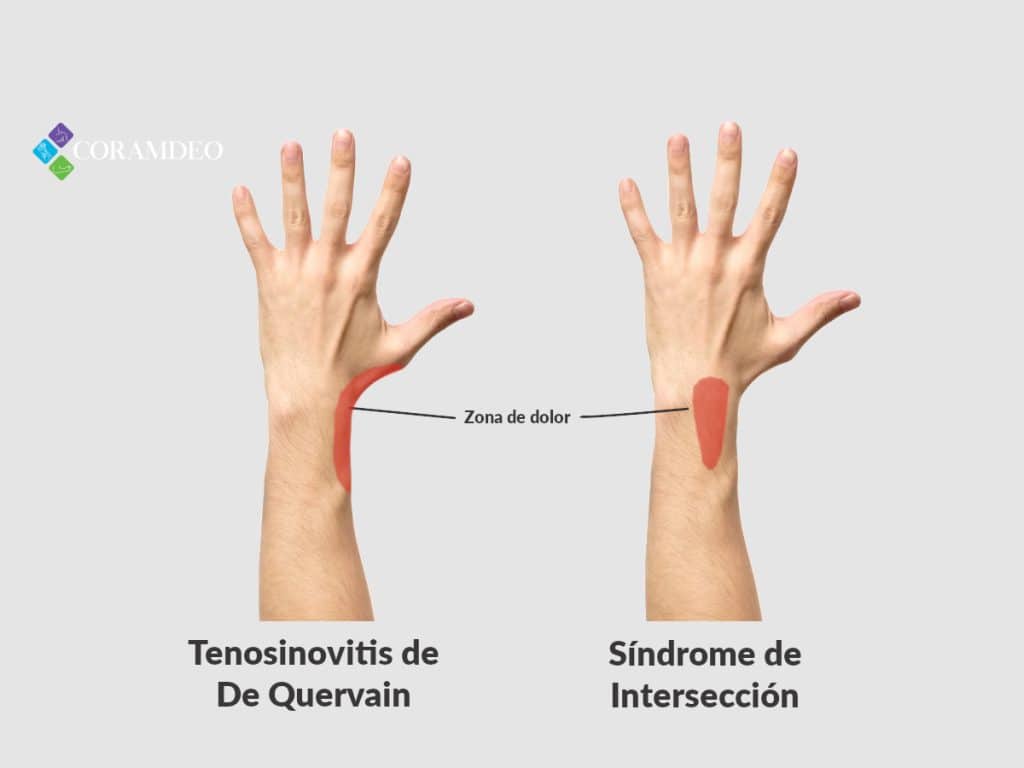 Diferencias entre sindrome de intersección y de quervain