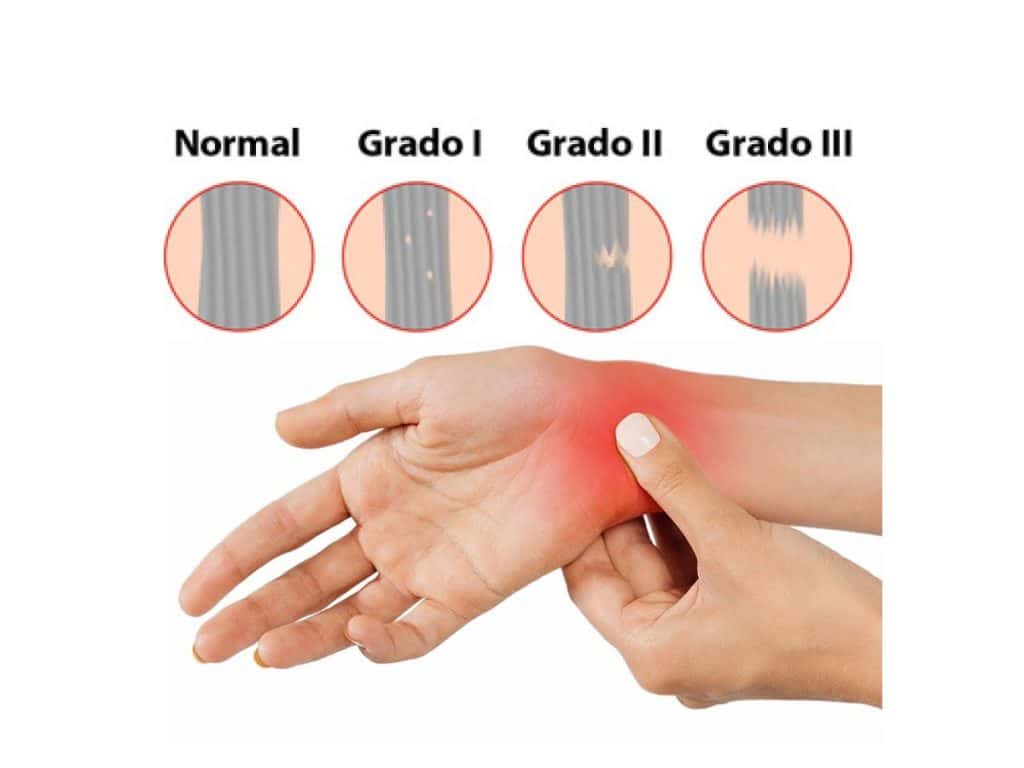 Tipos de esguince